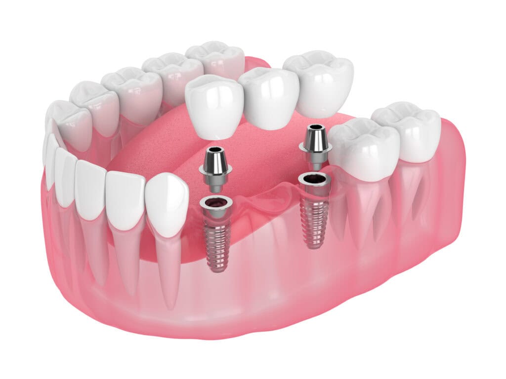 3d render of jaw with implants supported dental bridge