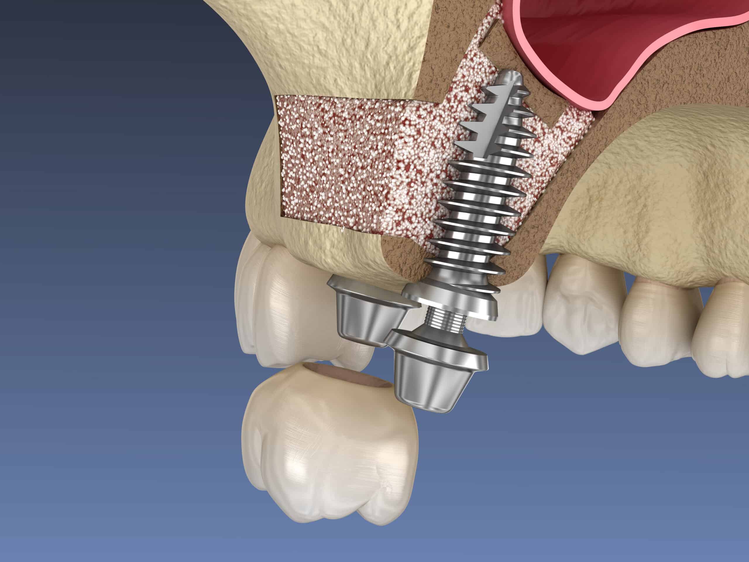 Sinus Lift Surgery - implant installation. 3D illustration